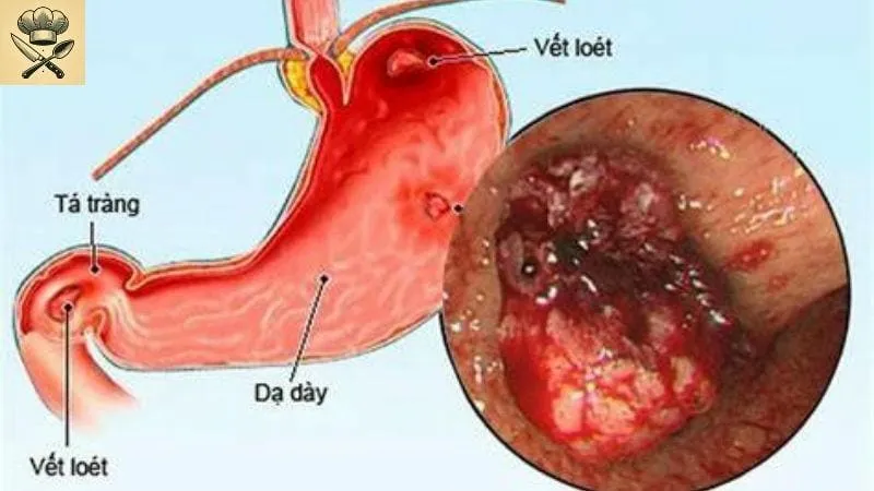 Loét dạ dày uống gì để giảm đau và hỗ trợ phục hồi? 1