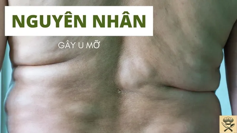 Cách uống nước hỗ trợ làm giảm u mỡ tự nhiên ngay tại nhà 2