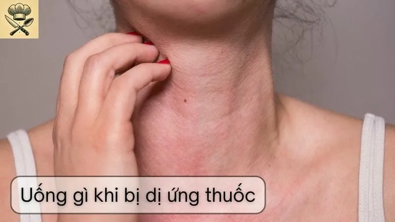 Uống gì khi bị dị ứng thuốc - Hướng dẫn điều trị an toàn
