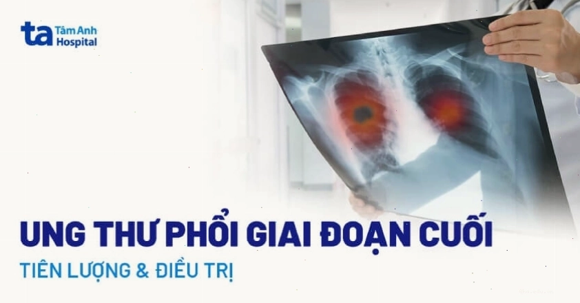 Ung thư phổi giai đoạn cuối và những điều cần biết