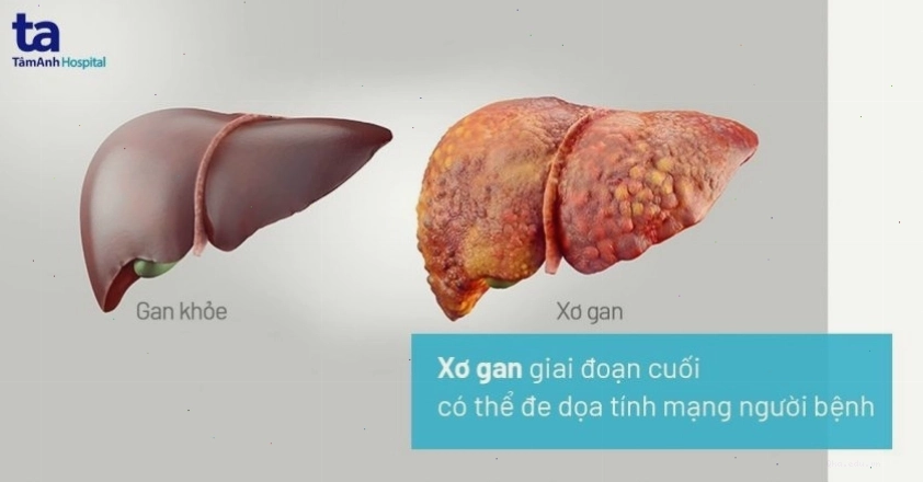 Xơ gan: Nguyên nhân, triệu chứng chẩn đoán và điều trị bệnh